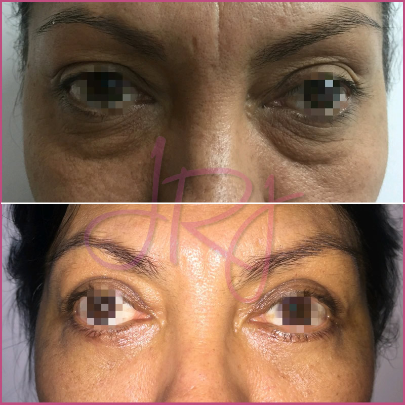 Blefaroplastia