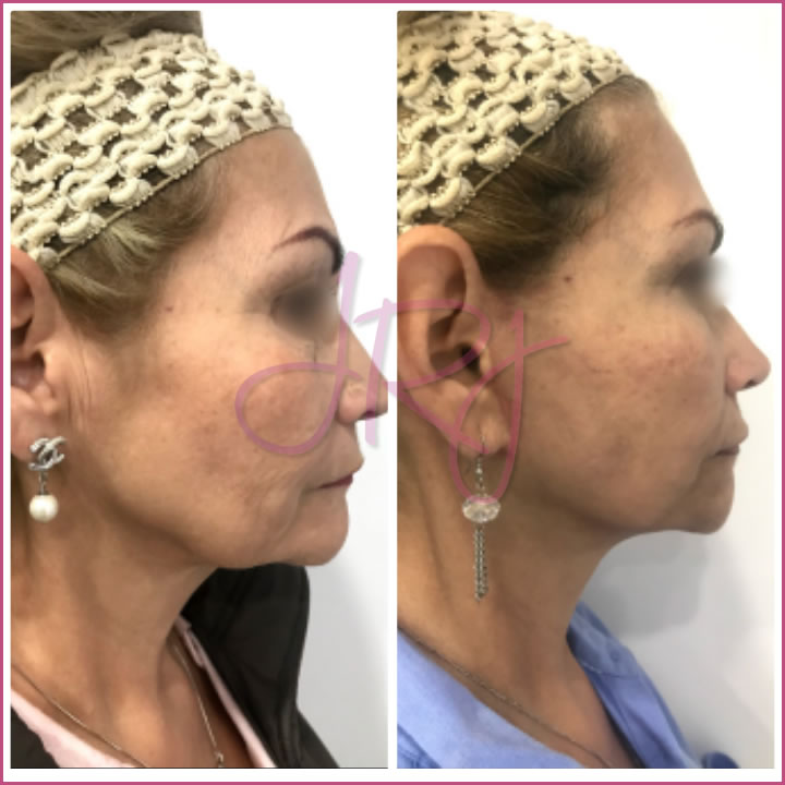 Ritidectomía (lifting facial)