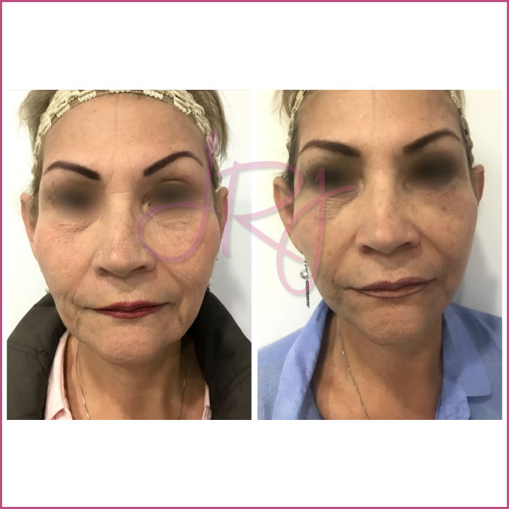Ritidectomía (lifting facial)