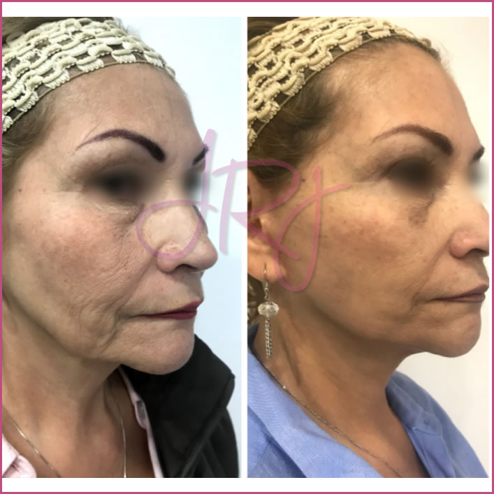 Ritidectomía (lifting facial)