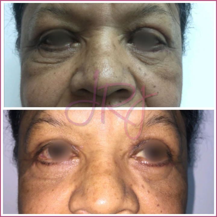 Blefaroplastia