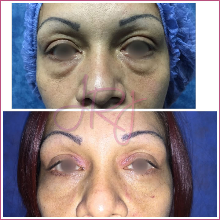 Blefaroplastia