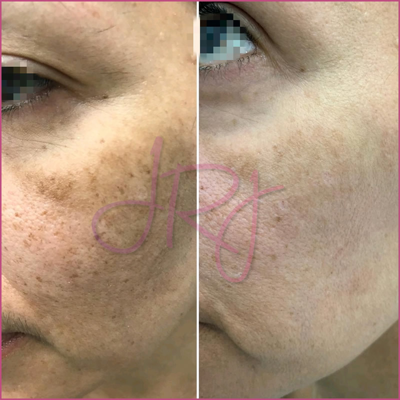 Dermapen o Microneedling
