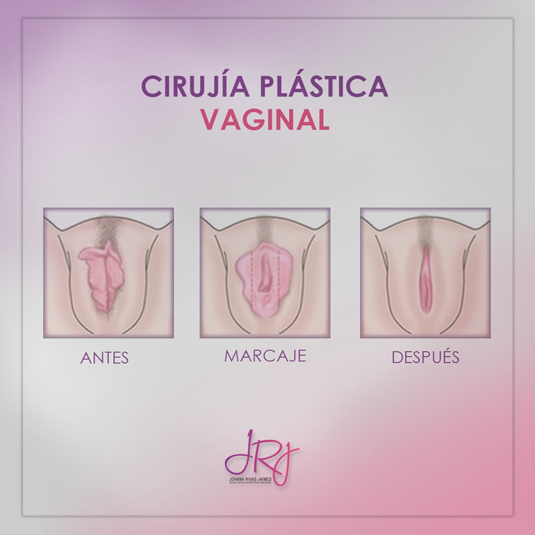 Cirugía de Genitales Externos