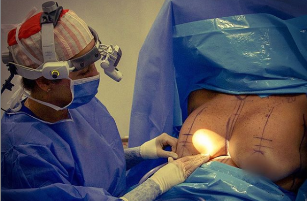 Mastopexia con implantes